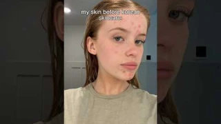 I tried a Korean skincare routine for 3 weeks heres the results so far✨see description 👇🏼😘🫶🏼