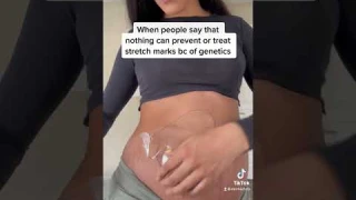 Clinically proven stretch mark treatment ❤️