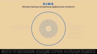 Линзы MiYOSMART с технологией D.I.M.S.