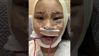 Plastic surgery transformation in Korea #idhospital #shorts