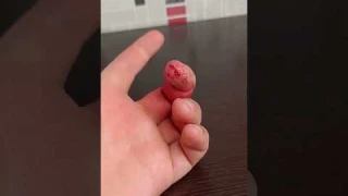 Как избавиться от укуса суслика. Последствия укуса