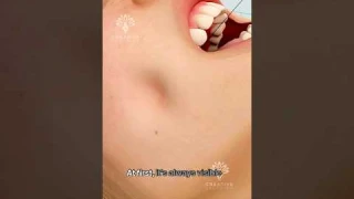 How Dimple Surgery Works 😲#short #dimpleplasty - Creativelearning3d