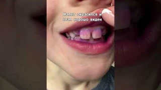 Как увидеть налет на зубах #зубы #стоматология #гигиенаполостирта