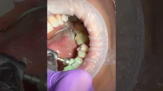 Как проходит ГИГИЕНА полости рта?😲👄Проф. ЧИСТКА зубов🦷 #гигиенаполостирта   #имплантация_зубов