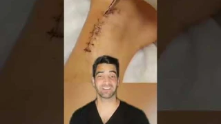 Staple Removal