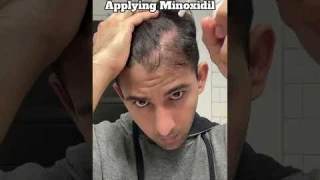 Day-85 Applying Minoxidil Till i Recover Hairline #hairloss #haircare #hairgrowth #minoxidil