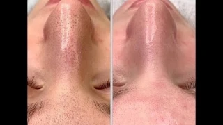 Ультразвуковой очиститель пор. Как избавиться от черных точек?