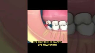 Что будет если не удалять зубы мудрости?🦷 #стоматолог #стоматология #зубмудрости