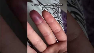 сломала палец
