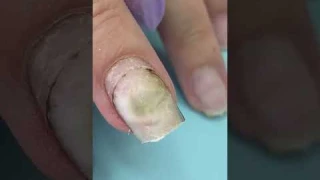 What Happened 🤢After Using Nail Glue