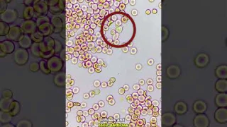White blood cells fight infection under the microscope! RARE FOOTAGE!